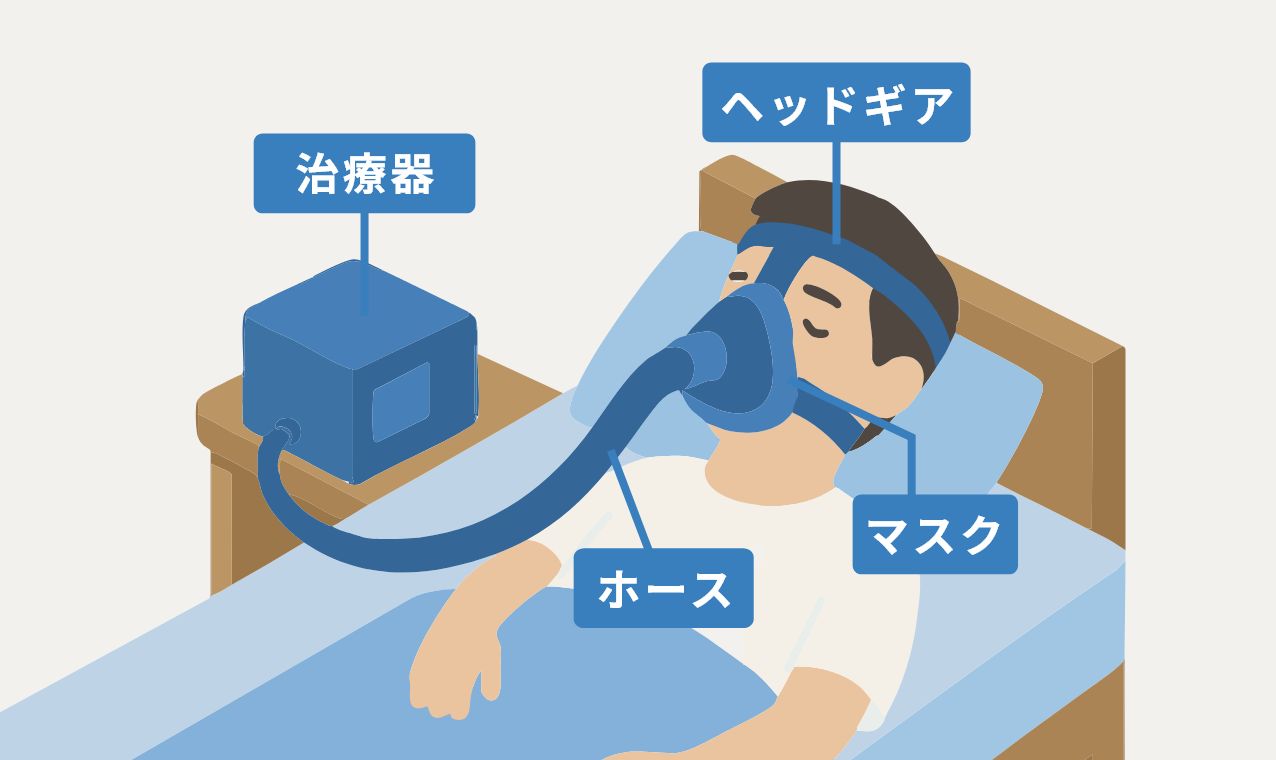 CPAP装置の仕組みの紹介イラスト